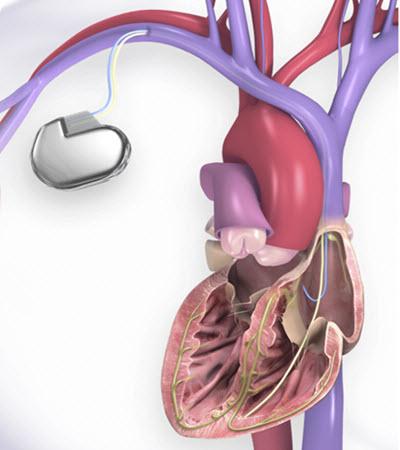 心脏和ICD的图示